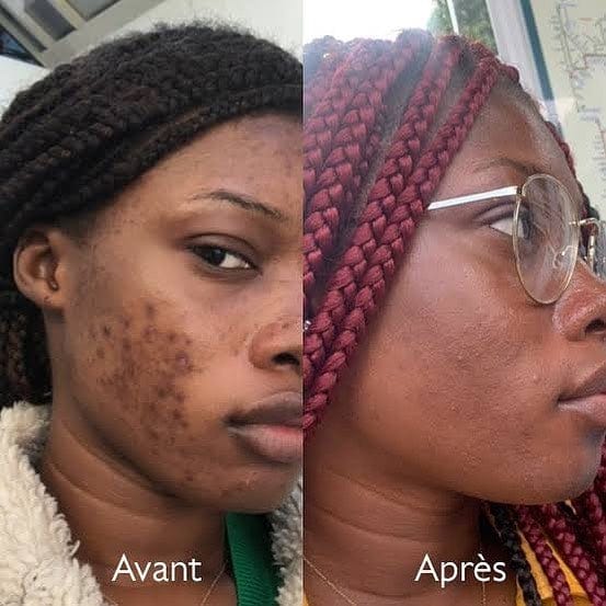Savon anti - taches au curcuma | 100% Naturel (CFQ)