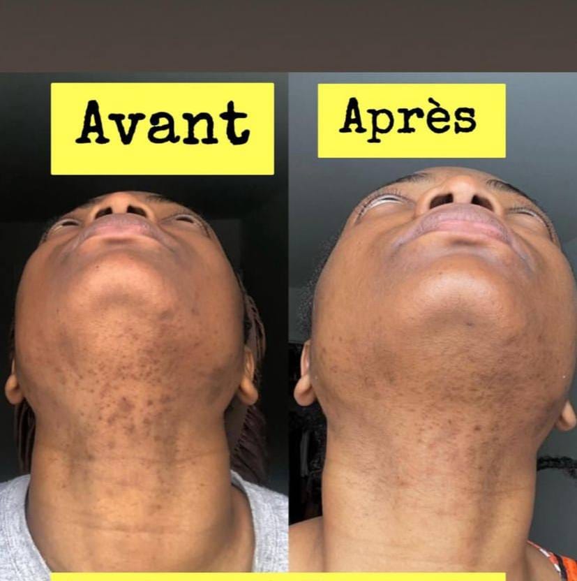 Savon anti - taches au curcuma | 100% Naturel (CFQ)