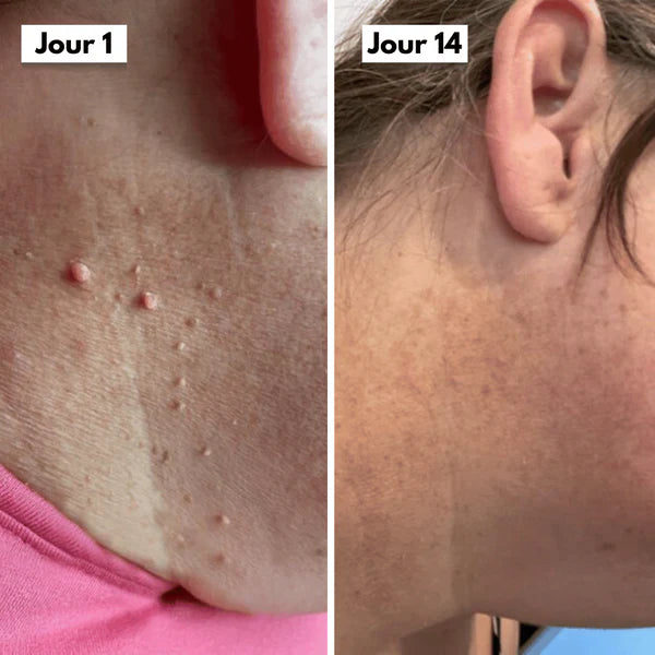 Kit DermaSkin Pro™ – Adieu Les Acrochordons, Résultat Immédiat